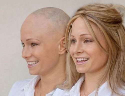 Алопеція, симптоми, лікування народними засобами