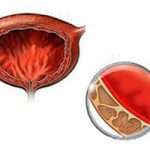 Як вилікувати цистит народними засобами