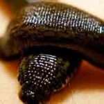 Гірудотерапія: лікування пявками