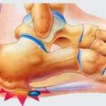 Як позбутися від пяткової шпори