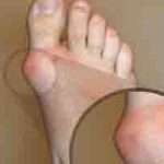 Як вилікувати подагру — народні рецепти