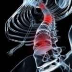 Як вилікувати спондилоартроз народними засобами