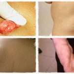 У вас ліпома? Не впадайте у відчай