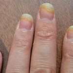 Нігтьовий грибок — лікування народними засобами