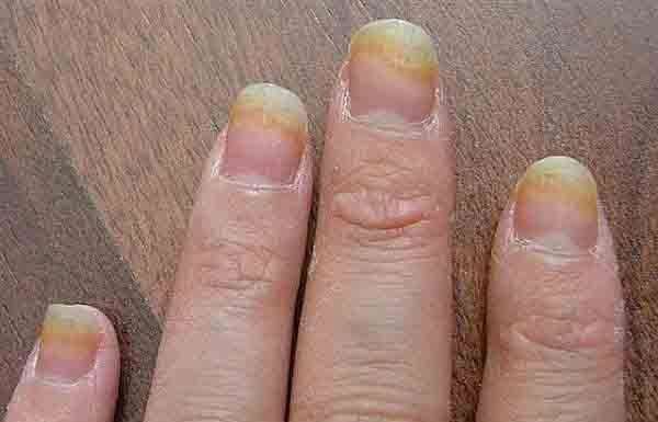 Нігтьовий грибок — лікування народними засобами