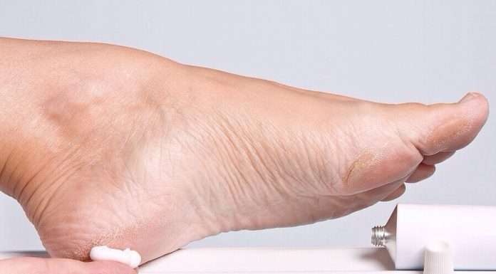 Натоптиші легше попередити, але і вилікувати нескладно