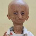 Діагноз «прогерия» — молодий старий