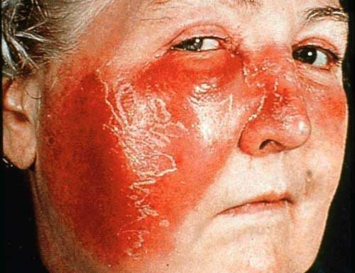 Як вилікувати бешихове запалення народними засобами