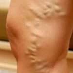 Профілактика варикозу народними засобами