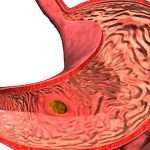 Як лікувати антральний гастрит засобами народної медицини?