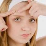 Вугрі: лікування народними засобами