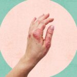 Псоріаз на руках і ногах: симптоми, наслідки та сучасні методи лікування