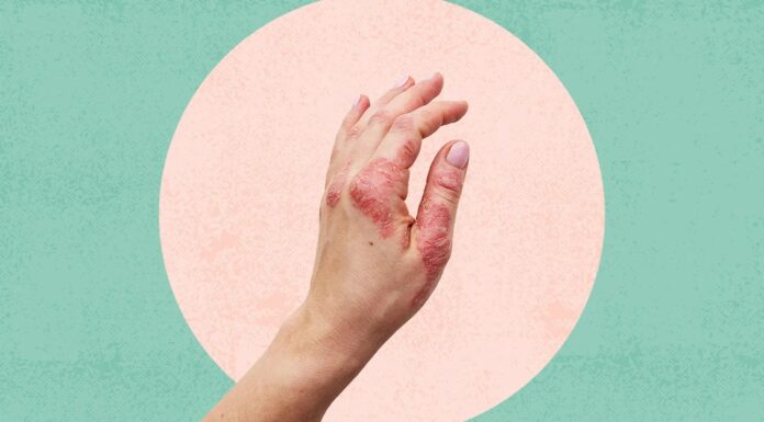 Псоріаз на руках і ногах: симптоми, наслідки та сучасні методи лікування
