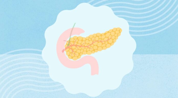 Трансплантація підшлункової залози для діабету 1 типу: рідкісний, але можливий варіант