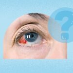 Субкон’юнктивальний крововилив: розуміння кривавих очей і коли звертатися за допомогою