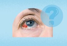 Субкон’юнктивальний крововилив: розуміння кривавих очей і коли звертатися за допомогою
