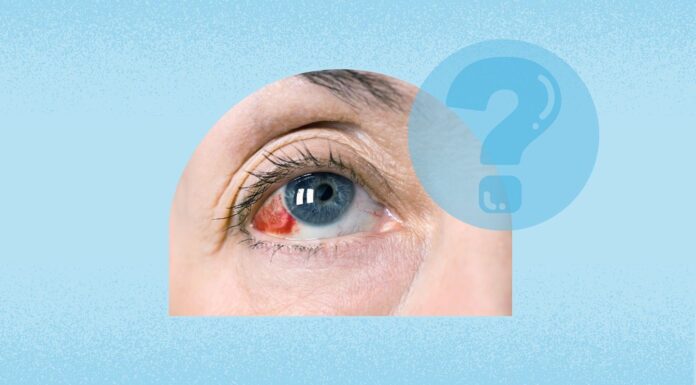 Субкон’юнктивальний крововилив: розуміння кривавих очей і коли звертатися за допомогою