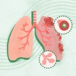 Хронічне обструктивне захворювання легень (ХОЗЛ): комплексний огляд