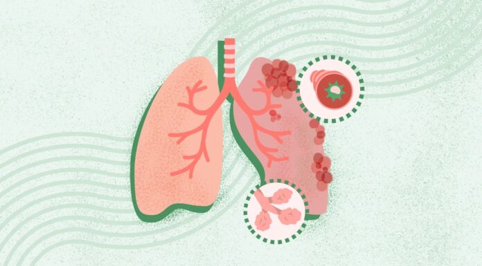 Хронічне обструктивне захворювання легень (ХОЗЛ): комплексний огляд