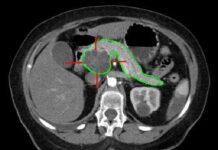 Прорив у лікуванні раку підшлункової залози: нова клітинна терапія продовжує життя