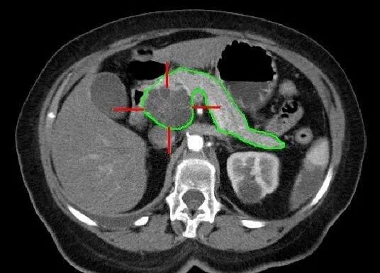 Прорив у лікуванні раку підшлункової залози: нова клітинна терапія продовжує життя