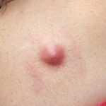 Понимание кожных новообразований: руководство по симптомам, причинам и необходимости обращения к врачу